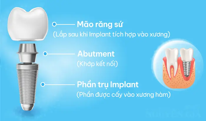 cau tao implant