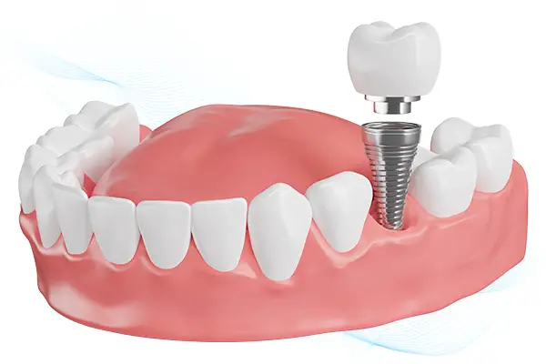 cay ghep implant nha khoa nguyen gia 0