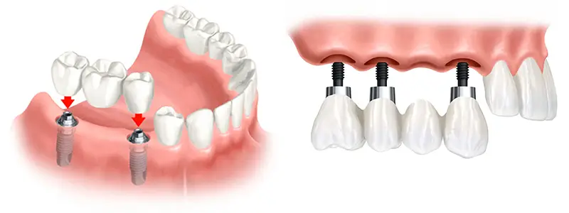 cay ghep implant nha khoa nguyen gia 2