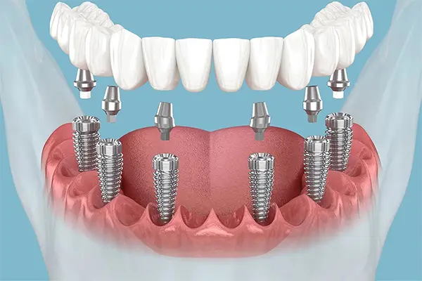 cay ghep implant nha khoa nguyen gia 6