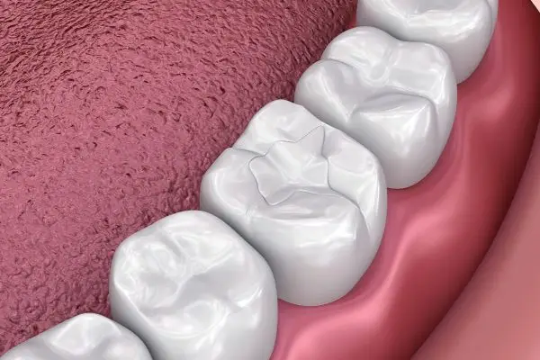 vComposite