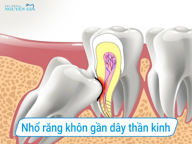 nhorangkhongandaythankinh
