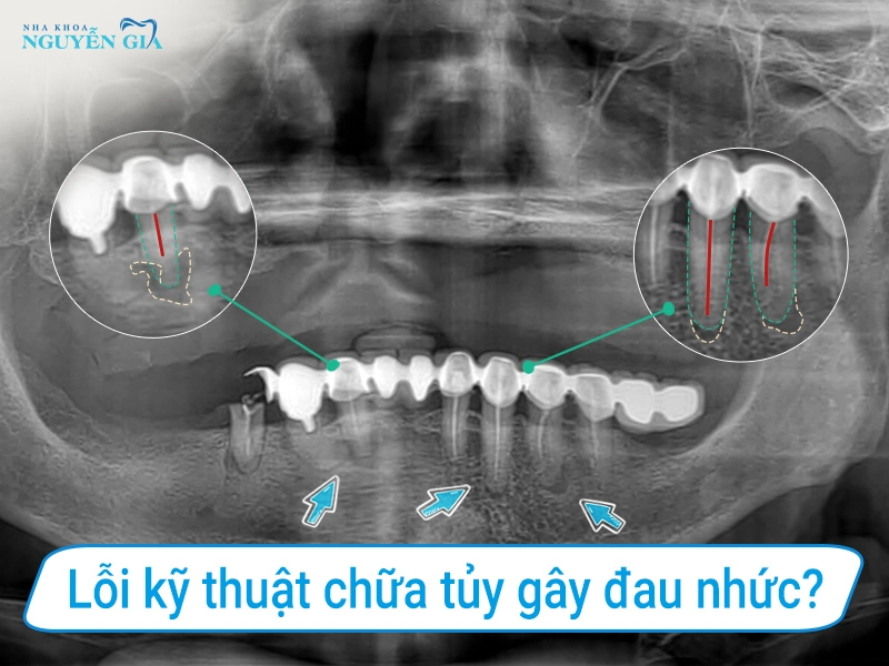 dieu tri tuy sai cach gay dau nhuc