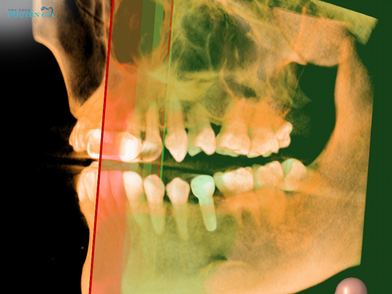 cac-yeu-to-anh-huong-thoi-gian-phuc-hoi-implant
