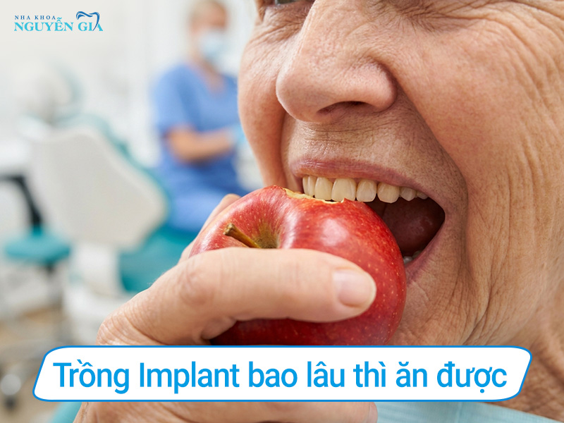 trồng răng implant bao lâu thì ăn được