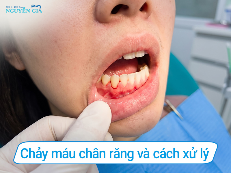 nguyên nhân chảy máu chân răng